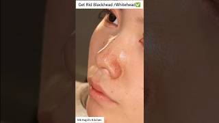 🔥Remove Blackheads amp Whiteheads Naturally  Get Rid Of Blackheads shorts blackheads ytshorts diy [upl. by Joete]