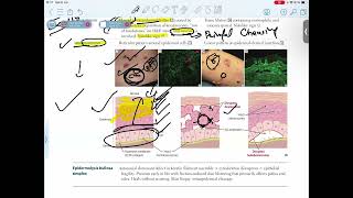 PEMPHIGUS VULGARISBULLOUS PEMPHIGOID [upl. by Fruma]