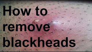 How to remove blackheads [upl. by Zeiger]