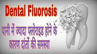 Dental Fluorosis  पानी में ज्यादा फ्लोराइड होने के कारण दांतों की परेशानी  treatment of fluorosis [upl. by Labinnah]