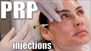 PRP Injections to Face and Neck Blood Facial [upl. by Uehttam]