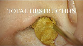 TOTAL OBSTRUCTION  EAR WAX REMOVAL  4KHD [upl. by Ativ]