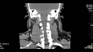 case 10  hoarseness of voice [upl. by Getter523]