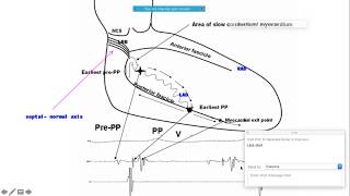 FascicularVT  Approach to ablation with basics ecgbasics bellhassenvt CardiacElectrophysiology [upl. by Attelrahc]