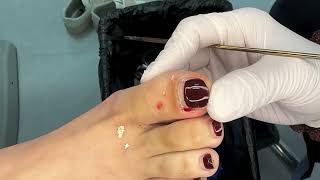 Satisfying ingrown toenail removal ❤❤❤❤ funny satisfying toenails 046 [upl. by Shawn]