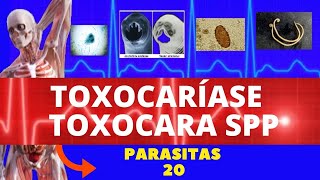 TOXOCARÍASE  TOXOCARA CANIS LARVA MIGRANS VISCERAL  PARASITOLOGIA INFECTOLOGIA [upl. by Remmos]