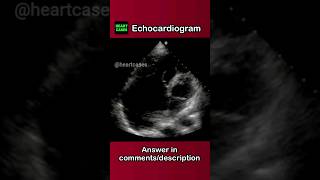 Echo case 8 Ebstein anomaly [upl. by Stoddard]