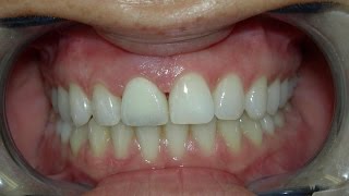 Cosmetic Dentist Recement Fallen Veneer [upl. by Clerissa876]