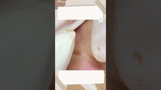 Big Cystic Acne Blackheads Extraction Blackheads amp Milia Whiteheads Removal Pimple Popping shorts [upl. by Leuneb]