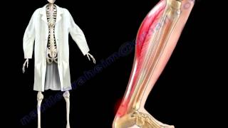 Achilles Tendon Stress amp Strain  Everything You Need To Know  Dr Nabil Ebraheim [upl. by Ntsyrk591]