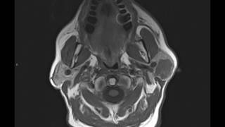 Carcinoma ex pleomorphic adenoma [upl. by Anitram]