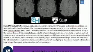 INTRACRANIAL SEPTIC EMBOLI [upl. by Dev]