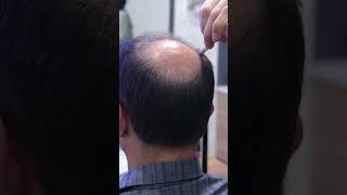 Hair Transplant in Istanbul [upl. by Yllehs170]