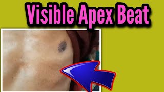 Visible apex beat including different type of apex beat [upl. by Heilman]