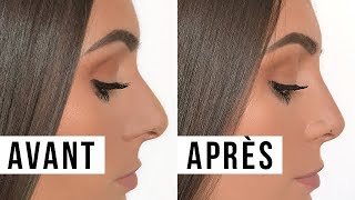 MA RHINOPLASTIE  AVANTAPRÈS PRIX EXPÉRIENCE etc│PerfectHonesty [upl. by Ramad851]