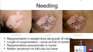 Combination of Needling and 308 Excimer Light for Treatment of Vitiligo [upl. by Alehc664]