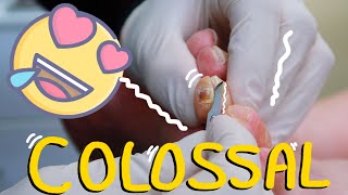 COLOSSAL Toe Corn Removal Satisfying removal with Nature background [upl. by Yelsiap]