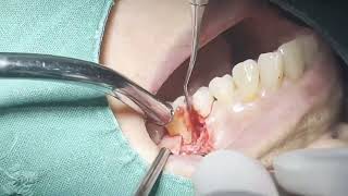 잇몸수술 periodontal surg flap op [upl. by Nickola]