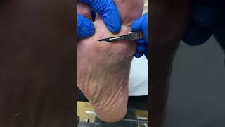 Say goodbye to hard skin amp corns Watch an Aussie podiatrist in action FootCare [upl. by Ettenirt]