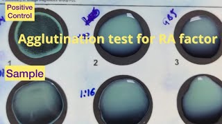 Agglutination test for detecting Rheumatoid factor [upl. by Twedy]