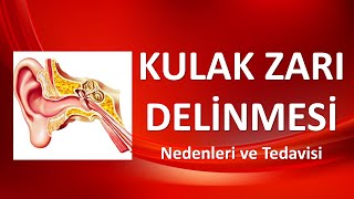 KULAK ZARI DELİNMESİ Belirtileri ve Tedavisi [upl. by Anigger]