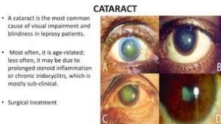 Effects of Leprosy on the Eyes [upl. by Willumsen]