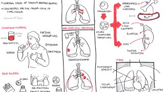 Lung Cancer  Overview [upl. by Namsu538]