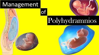 Management of Polyhydramnios [upl. by Terris]