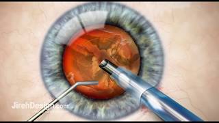 Phacoemulsification in Cataract Surgery HD [upl. by Rakel]