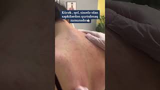 KÜRƏK AKNESİ  DERMATOLOQ [upl. by Halilahk]