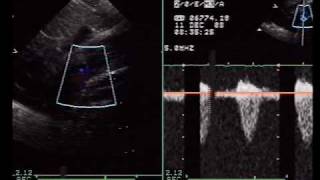 Severe Coarctation of the Aorta [upl. by Buhler]