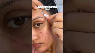 Pimple Patch Removal😱 acne pimplepatch pimplepatches acnepatch acnes acneproneskin pimplepop [upl. by Oag465]