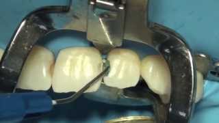 Tokuyama Dental Estelite Sigma Quick ile Restorasyon [upl. by Ahcire227]