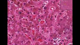 Histopathology LiverHemochromatosis [upl. by Aihsad]