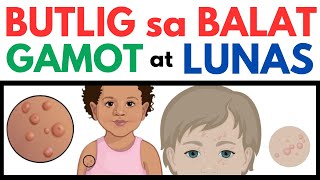 BUTLIG sa BALAT  Gamot at LUNAS  Home Remedies  Butlig sa Kamay Mukha Katawan at iba pa [upl. by Pape]