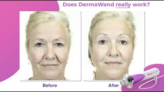 DermaWand Pro  Reduces Wrinkle Appearance in 1 WEEK Clinicallyproven radiofrequency device [upl. by Cowie]