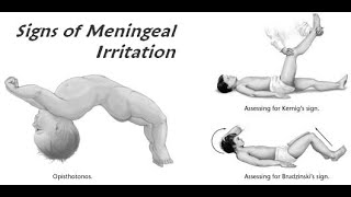 Meningeal signs in Neurological examination Brudzunski Kernigs Nuchal rigidity Opisthotonos [upl. by Dorcas]