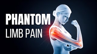 Understanding Phantom Limb Pain  Your Guide to Relief [upl. by Saval128]