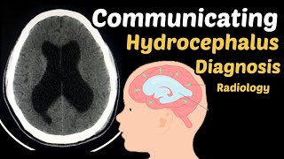 Communicating Hydrocephalus Diagnosis  Cerebrospinal Fluid  Ventricle’s of the Brain  Ct Brain [upl. by Atiuqram]