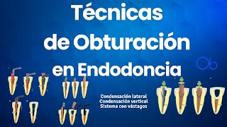 Técnicas de Obturación en Endodoncia 🦷 [upl. by Selmore101]