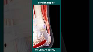 Tendon Repair  tendon rupture treatment anatomy education [upl. by Kore356]