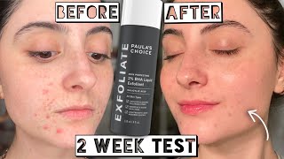 Testing Paula’s Choice 2 BHA LIQUID EXFOLIANT for Acne amp Scarring for 2 weeks [upl. by Akemyt]