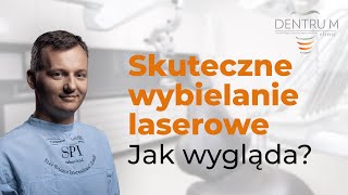 Wybielanie zębów skuteczne jak wygląda wybielanie laserowe Opowiada Queen of smile [upl. by Gun397]