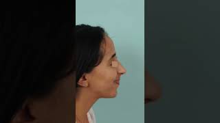 Rhinoplastie ultrasonique  Bosse très marquée [upl. by Laamaj]