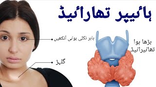 Thyroid  گلھڑ کا مرض Hyperthyroidism  Wajoohaat Nishaniyan ilaj [upl. by Ynneh278]