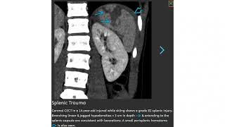 Splenic Trauma In The Imaging [upl. by Nylegna436]