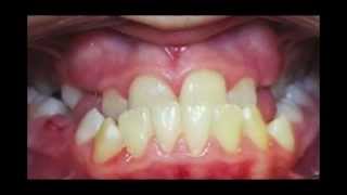 Underbite Correction Time Lapse Video Kyger Orthodontics [upl. by Aizirk]