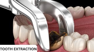 Things You Dont Know About Tooth Extraction [upl. by Addis444]