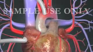 Operasi Bypass Jantung  CABG [upl. by Cate]