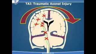 Traumatic Brain Injury  Part 3 [upl. by Keli]